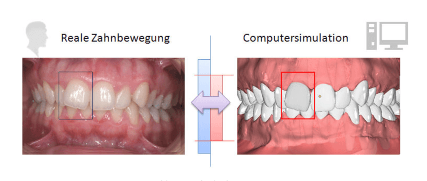 Digitale Kieferorthopädie Hannover - Digitale Befundsauswertung - Erstellung digitaler Setups