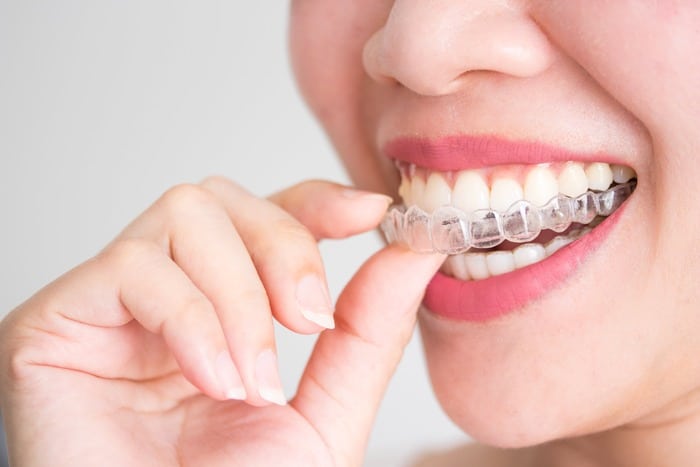 Invisalign® Lite - Smart Track - Kieferorthopädie Hannover Dr. Entrup