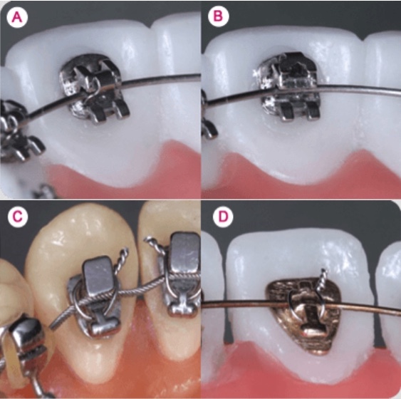 Lingual Technique KFO Hannover - Spring-Clip-System (A: closed, B: open for archwire exchange, in comparison to two older systems with wire ligature